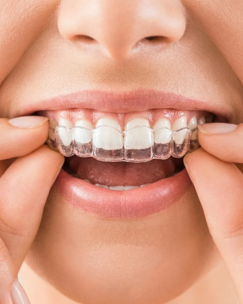Sorriso com alinhador transparente quase imperceptível